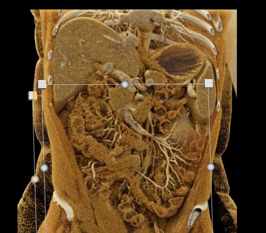 Enteritis Involves the Jejunum - CTisus CT Scan
