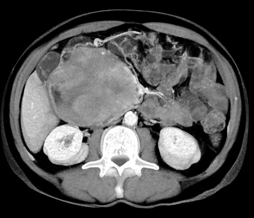 Duodenal GIST Tumor - CTisus CT Scan