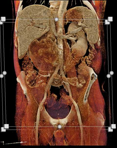 Duodenal GIST Tumor - CTisus CT Scan