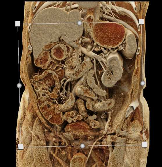 Crohn's Disease - CTisus CT Scan