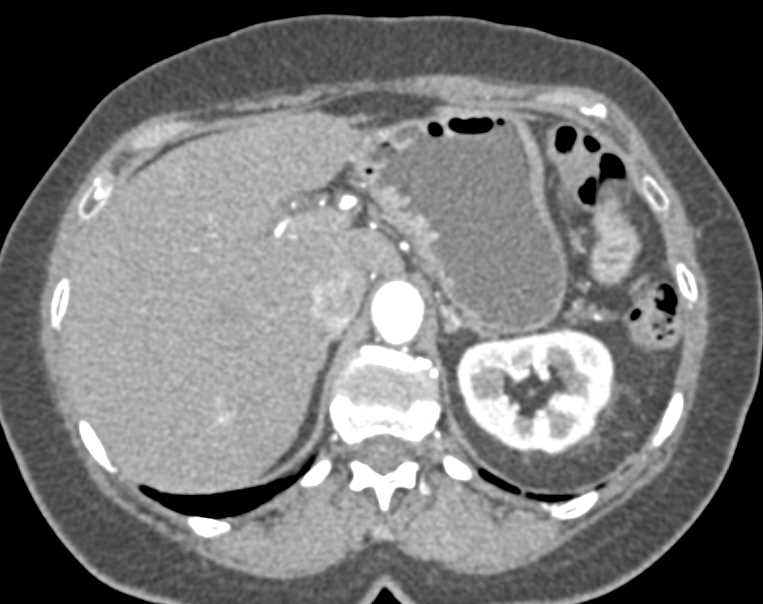 Carcinoid Tumor in Root of Mesentery - CTisus CT Scan