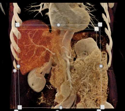 Carcinoid Tumor in Root of Mesentery - CTisus CT Scan