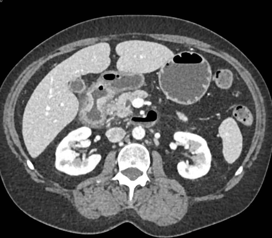 Duodenal Cancer - CTisus CT Scan