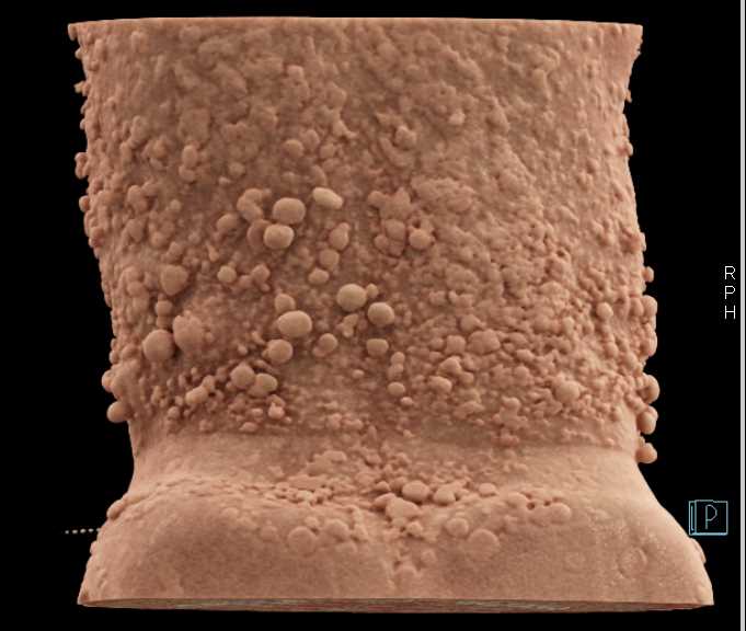 Neurofibromatosis with Small Bowel Tumors - CTisus CT Scan