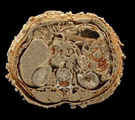 Neurofibromatosis with Small Bowel Tumors - CTisus CT Scan