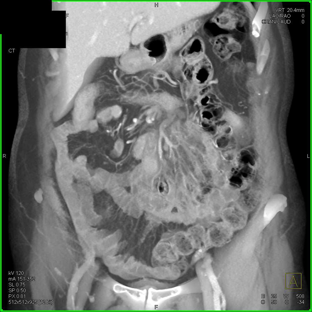 Jejunal Diverticulitis - CTisus CT Scan