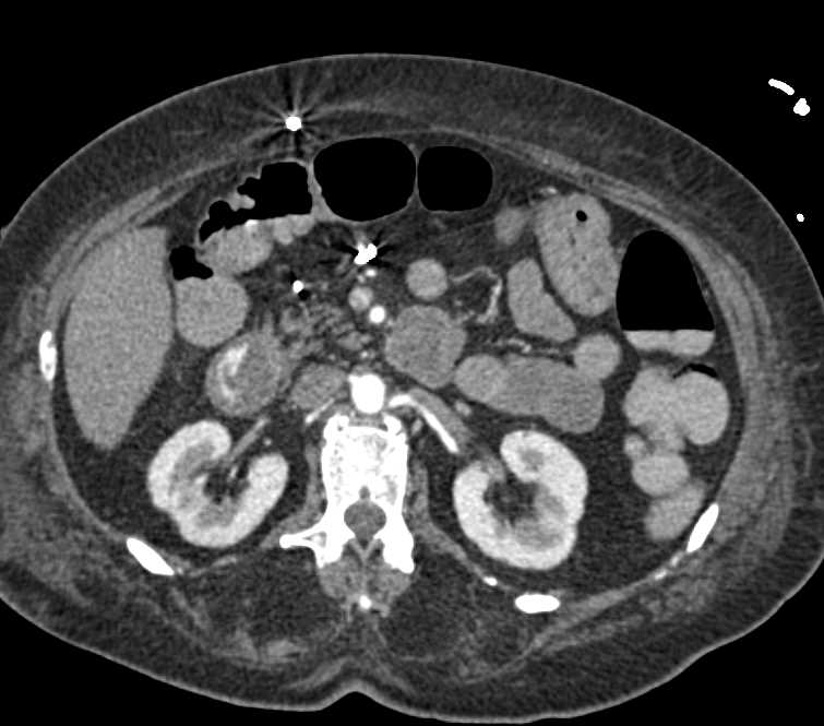 Active Bleed in the Duodenum - CTisus CT Scan