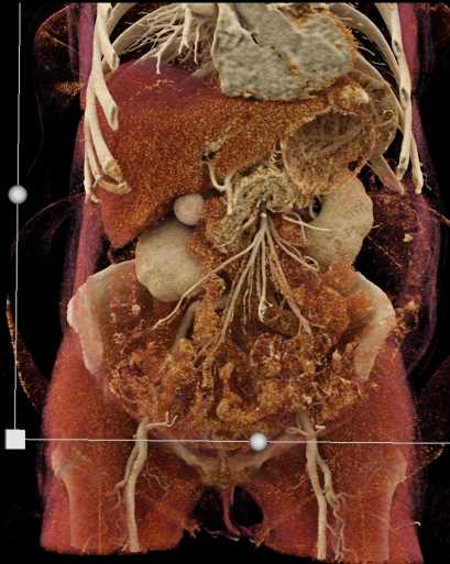 Small Bowel Carcinoid Tumors - CTisus CT Scan