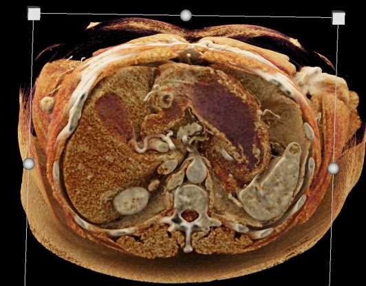 Carcinoid Tumor in the Right Lower Quadrant as well as Bladder Cancer - CTisus CT Scan