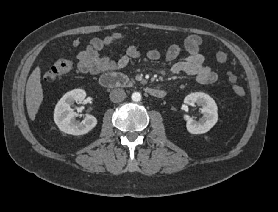 Carcinoid Tumor in the Root of the Mesentery - CTisus CT Scan