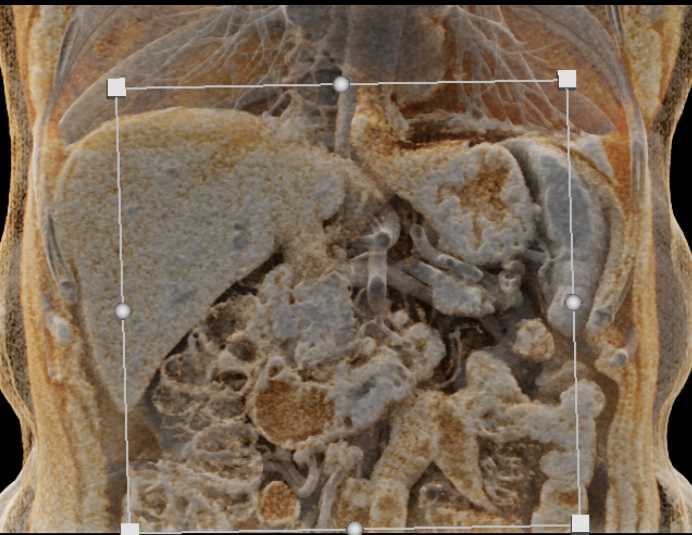 Adenocarcinoma 4th Portion Duodenum - CTisus CT Scan