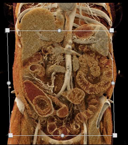 Intraluminal Mass with Intusuception RLQ - CTisus CT Scan