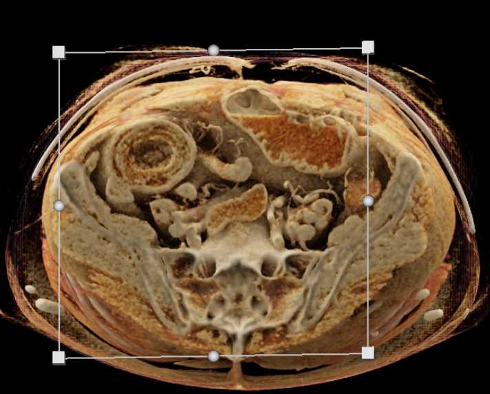 Intraluminal Mass with Intusuception RLQ - CTisus CT Scan