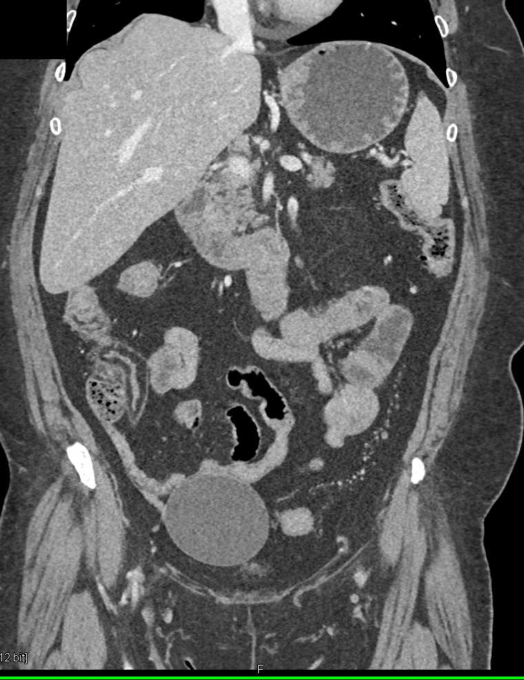 Crohn's Disease - CTisus CT Scan