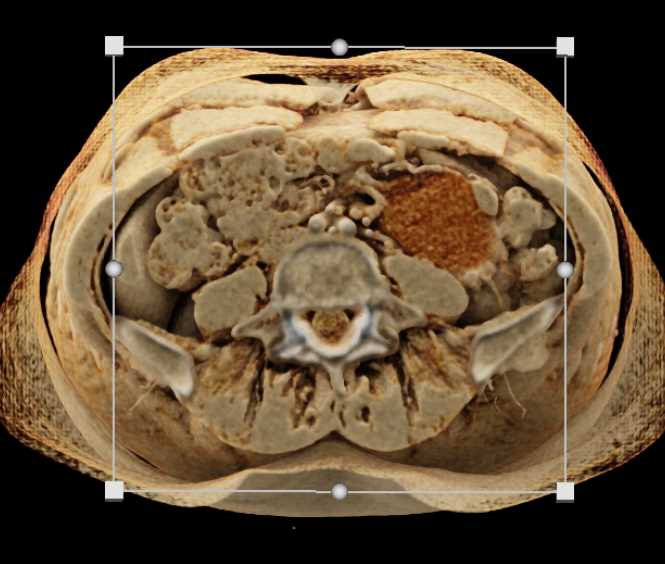 Mesenteric Cyst - CTisus CT Scan
