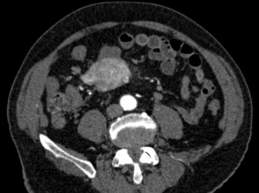 Carcinoid Tumor with Desmoplastic Reaction - CTisus CT Scan