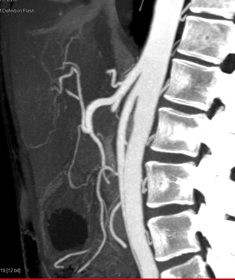 SMA Syndrome with Dilated Duodenum - CTisus CT Scan