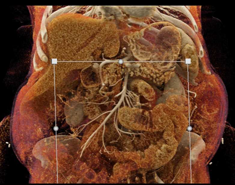 Neuroendocrine tumor in Duodenum - CTisus CT Scan