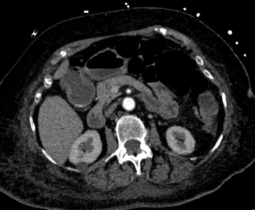 Enteritis - CTisus CT Scan