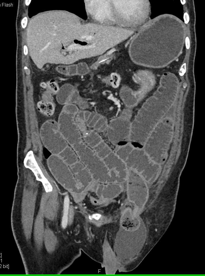 Small Bowel Obstruction (SBO) due to Left Inguinal Hernia - CTisus CT Scan