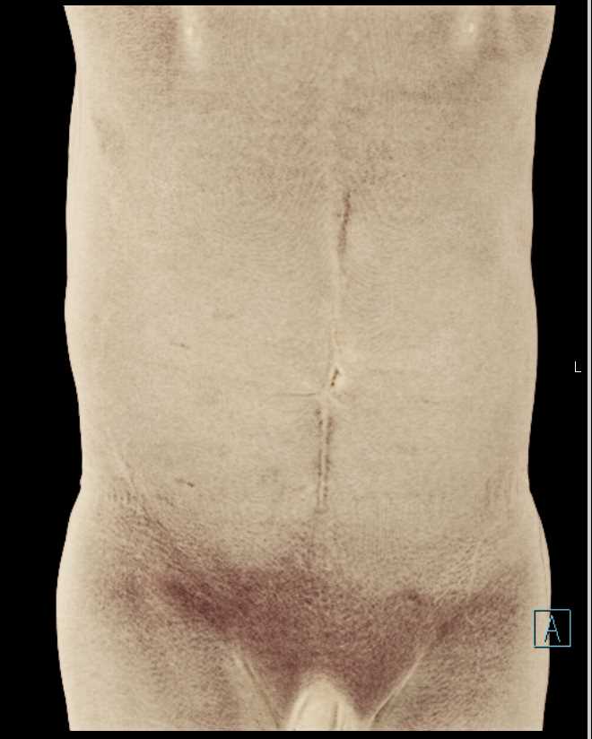 Small Bowel Obstruction (SBO) due to Left Inguinal Hernia - CTisus CT Scan