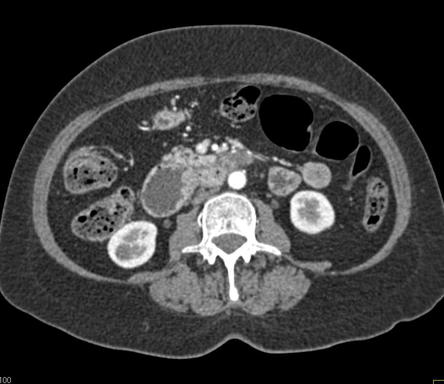 Duodenal Carcinoma with Obstruction - CTisus CT Scan