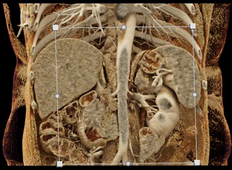 Duodenal Carcinoma with Obstruction - CTisus CT Scan