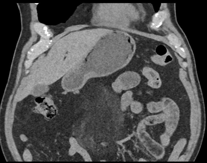 Mesenteric Panniculitis - CTisus CT Scan