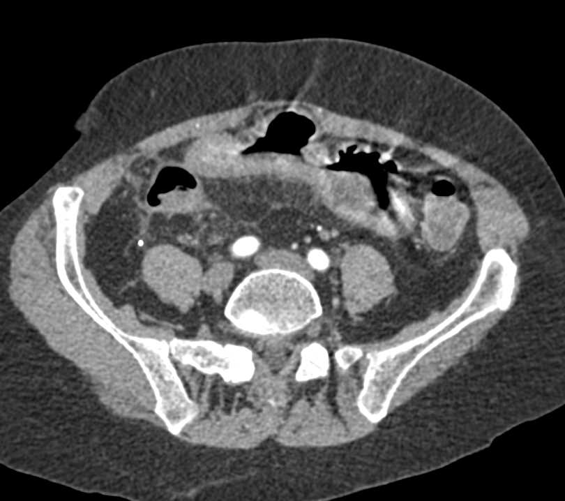 Extensive Crohn's Disease in the Distal Small Bowel - CTisus CT Scan