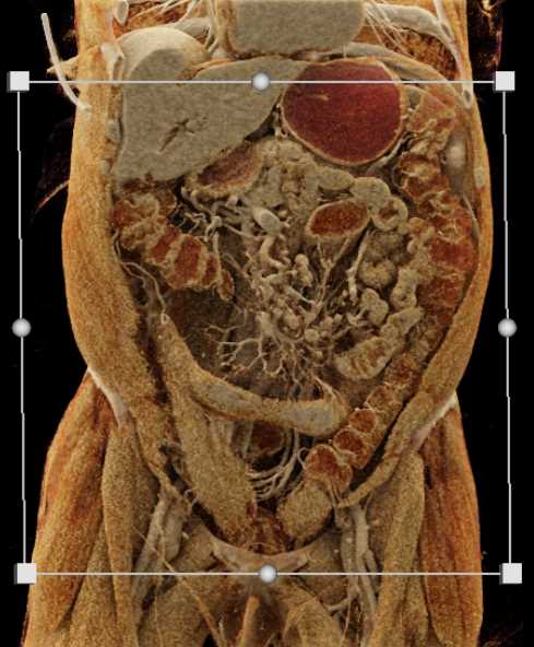 Extensive Crohn's Disease in the Distal Small Bowel - CTisus CT Scan