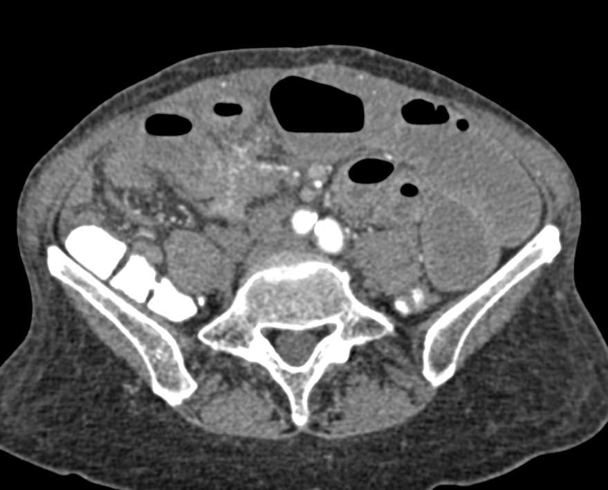 Carcinoid Tumor Ileum with Neovascularity - CTisus CT Scan