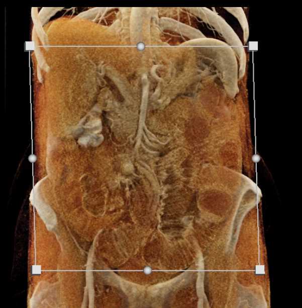 Carcinoid Tumor Ileum with Neovascularity - CTisus CT Scan