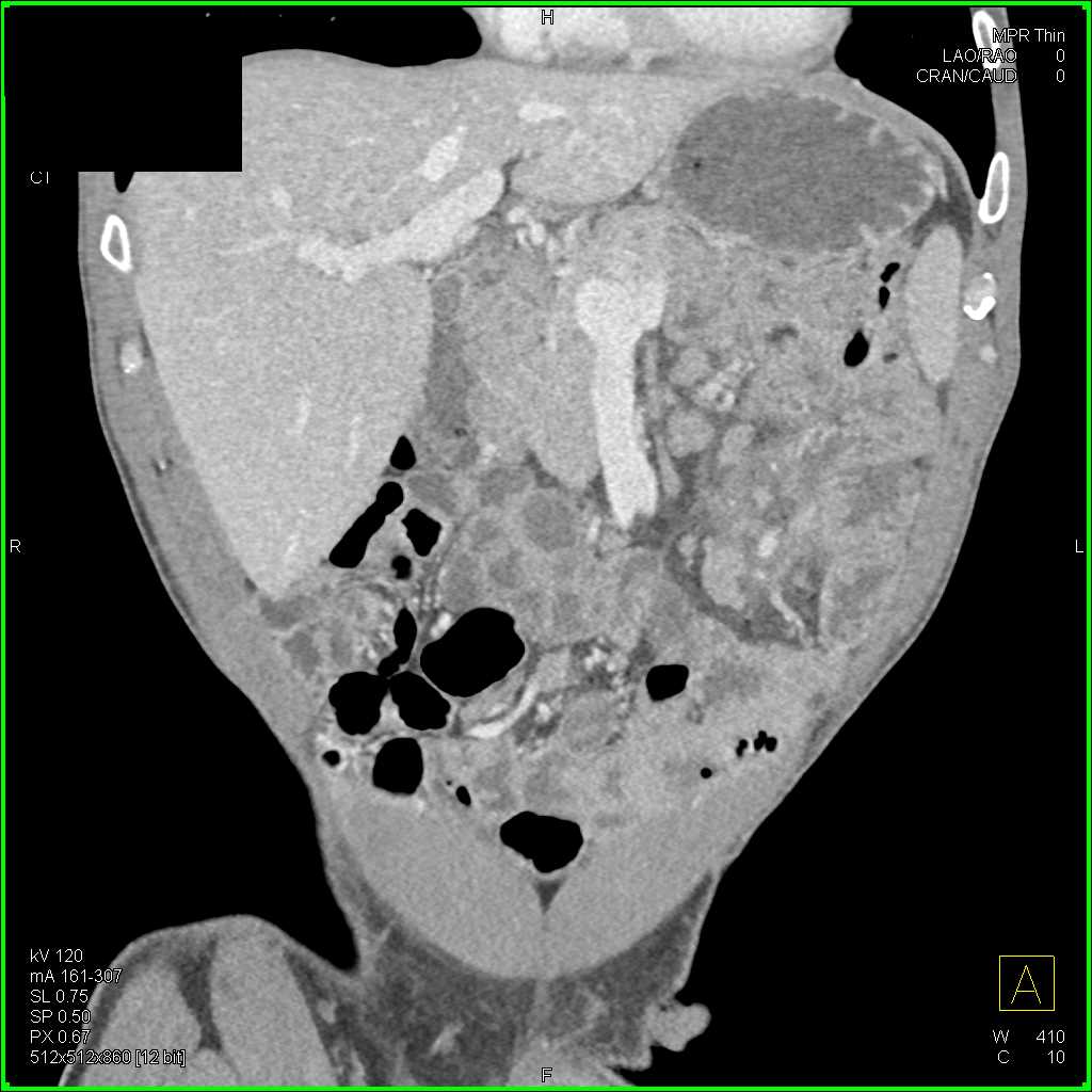 Lymphoma Small Bowel with Adenopathy - CTisus CT Scan