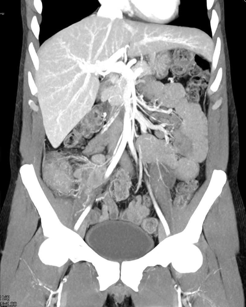 Salmonella Infection of Terminal Ileum and Cecum - CTisus CT Scan