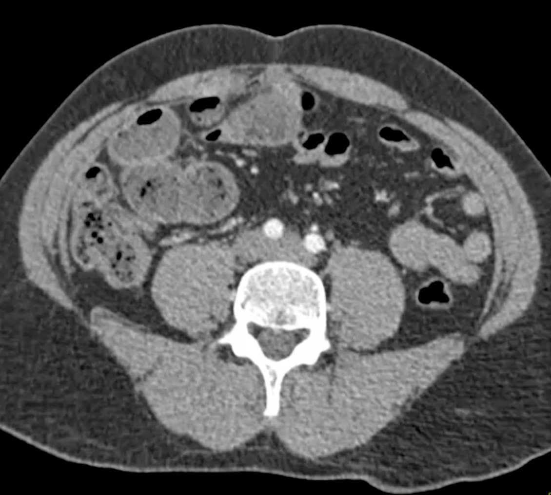 Small Bowel Obstruction (SBO) due to Closed Loop Obstruction with U Shaped Configuration - CTisus CT Scan