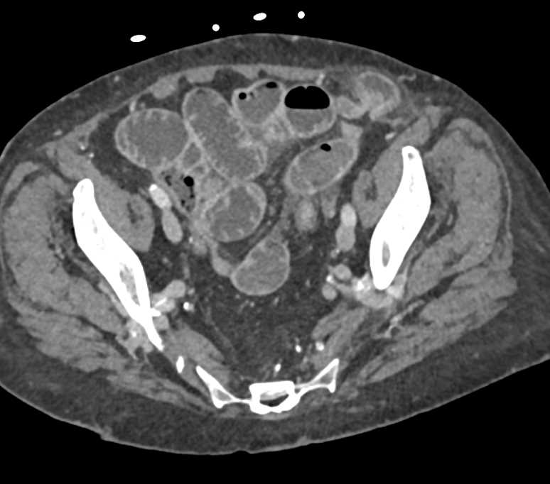 Spigelian Hernia LLQ - CTisus CT Scan
