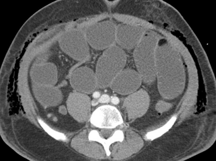 Spigelian Hernia post Robotic Prostatectomy - CTisus CT Scan