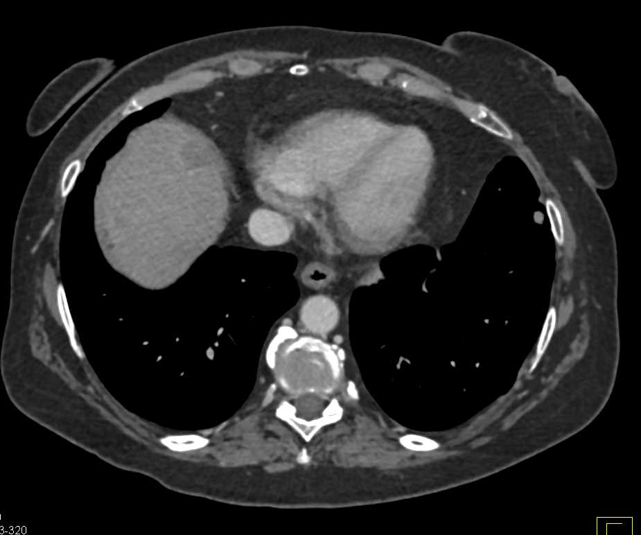 Carcinoid Tumor Root of Mesentery - CTisus CT Scan