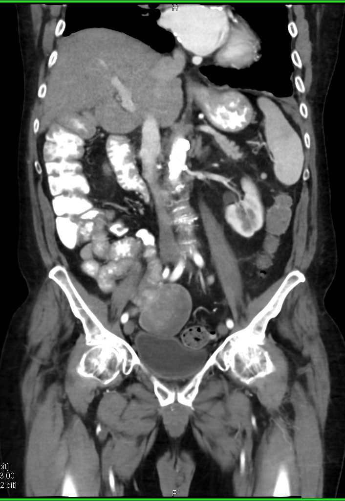 GIST Tumor Ileum - CTisus CT Scan