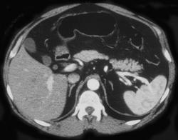 Nice Splenic Artery - CTisus CT Scan