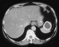 Calcified Splenic Cyst - CTisus CT Scan