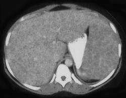Sarcoidosis - CTisus CT Scan