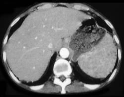 Sarcoidosis Lung & Spleen - CTisus CT Scan