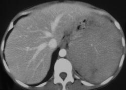 Splenic Lymphoma - CTisus CT Scan