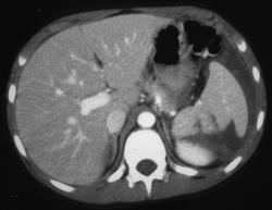 Splenic Infarction - CTisus CT Scan