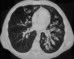 Splenic Infarction (cystic Fibrosis) - CTisus CT Scan