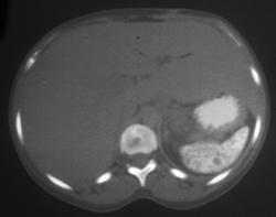 Sickle Cell Disease - CTisus CT Scan