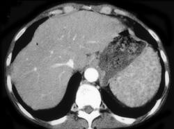 Sarcoidosis of the Spleen (and Lung) - CTisus CT Scan