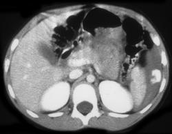 Splenic Laceration - CTisus CT Scan