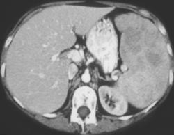 Splenic Lymphoma - CTisus CT Scan